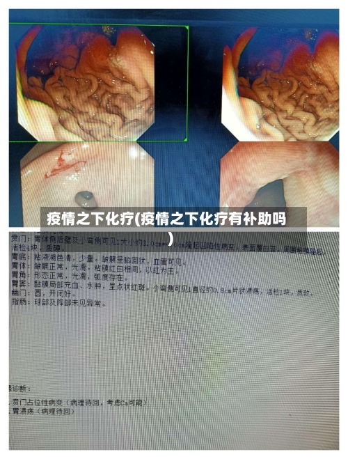 疫情之下化疗(疫情之下化疗有补助吗)